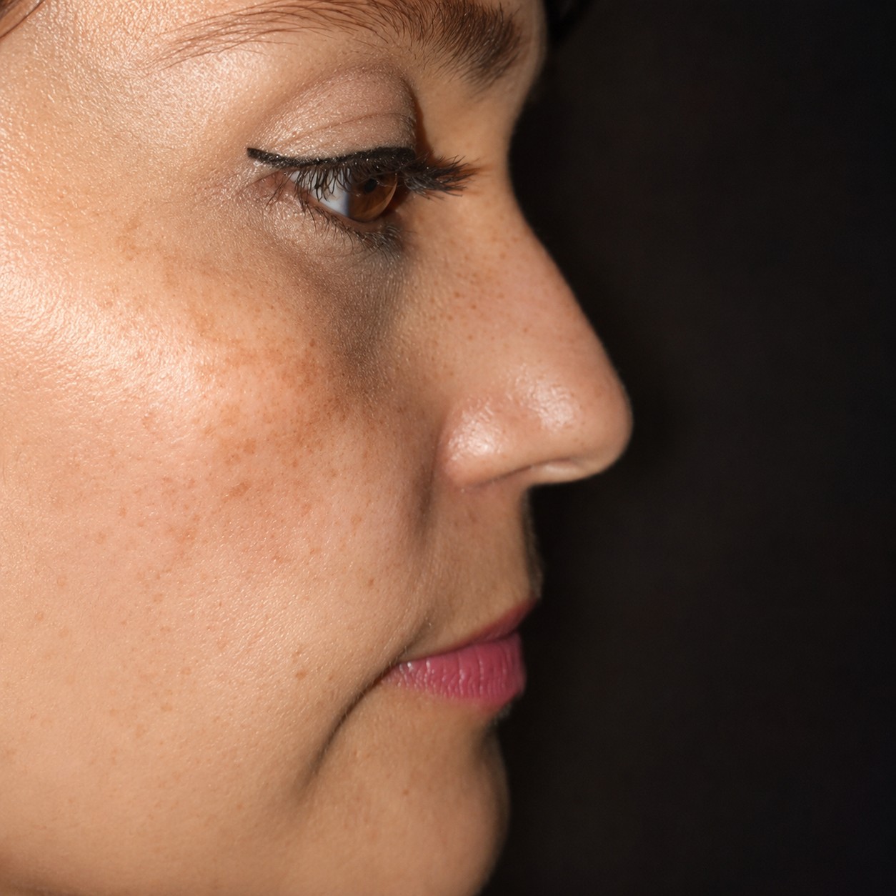 Antes de tratamiento de medicina estética facial