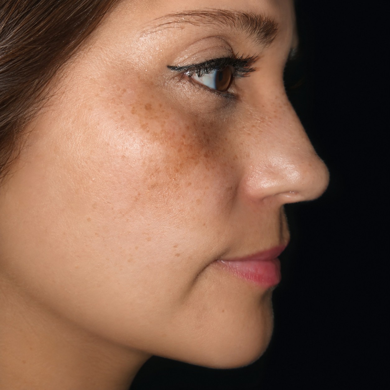 Después de tratamiento de medicina estética facial